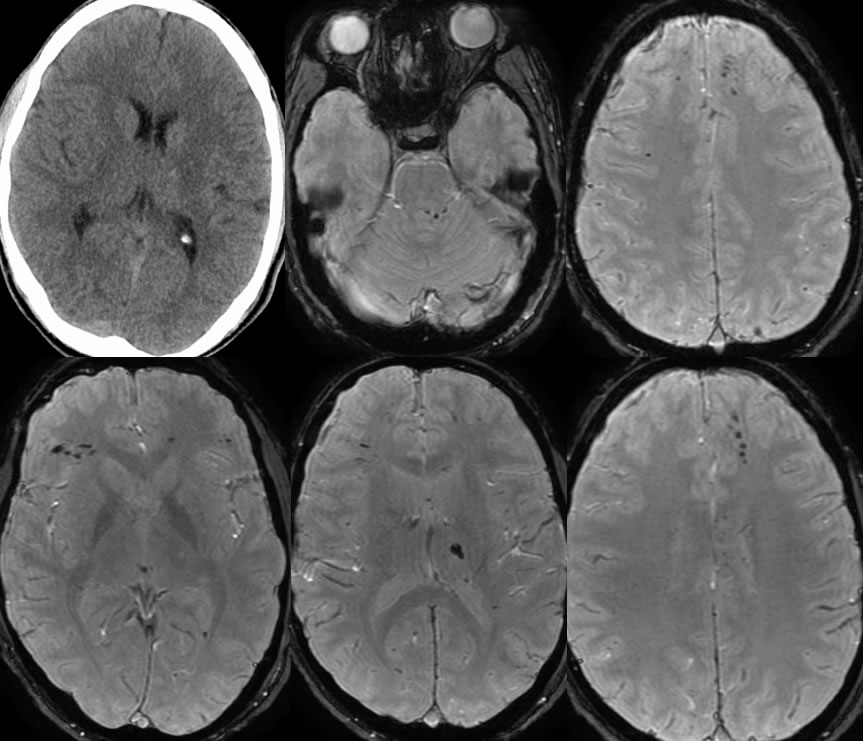 diffuse-axonal-injury